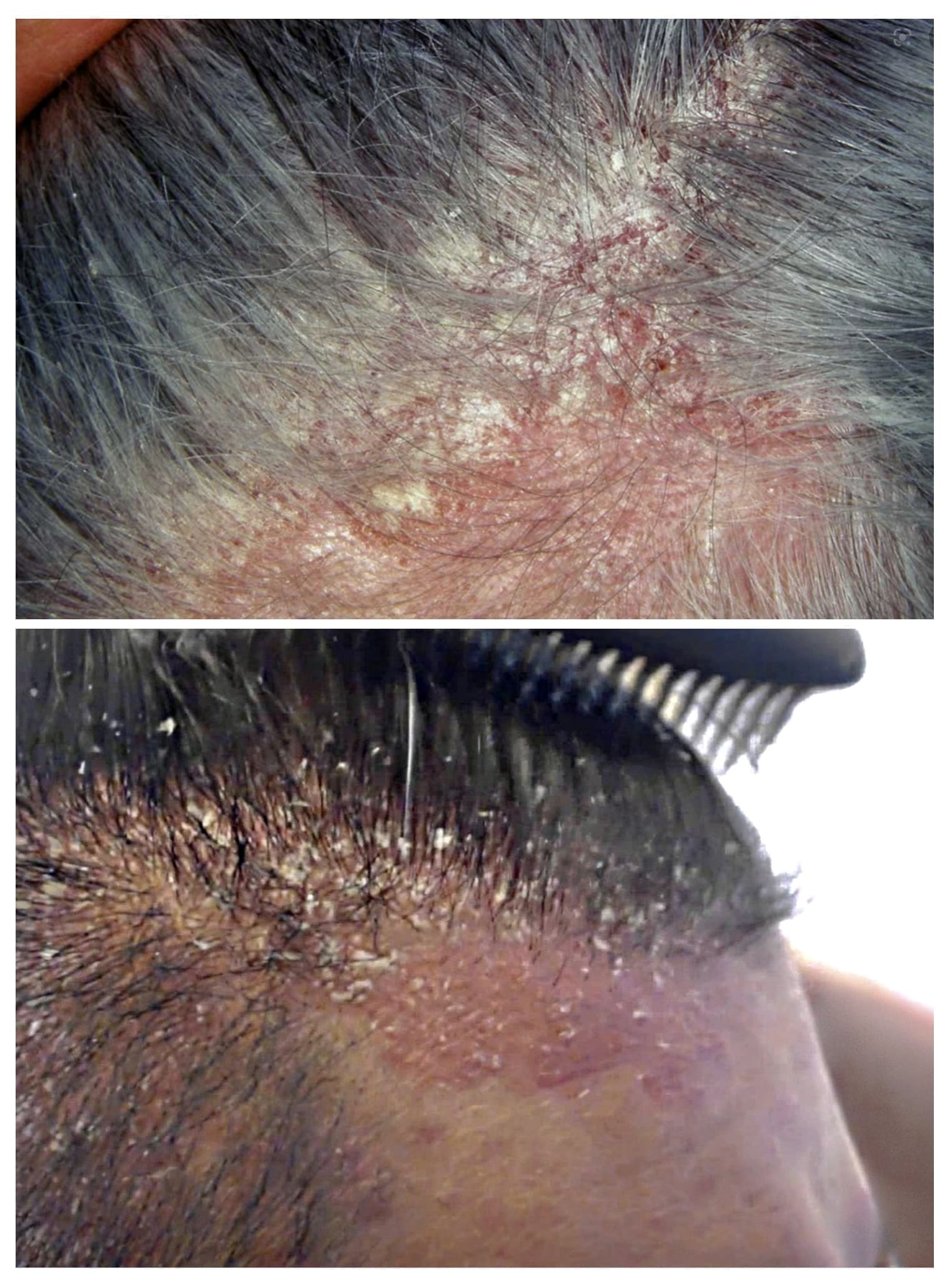 Dermatite Seborroica Cuoio Capelluto