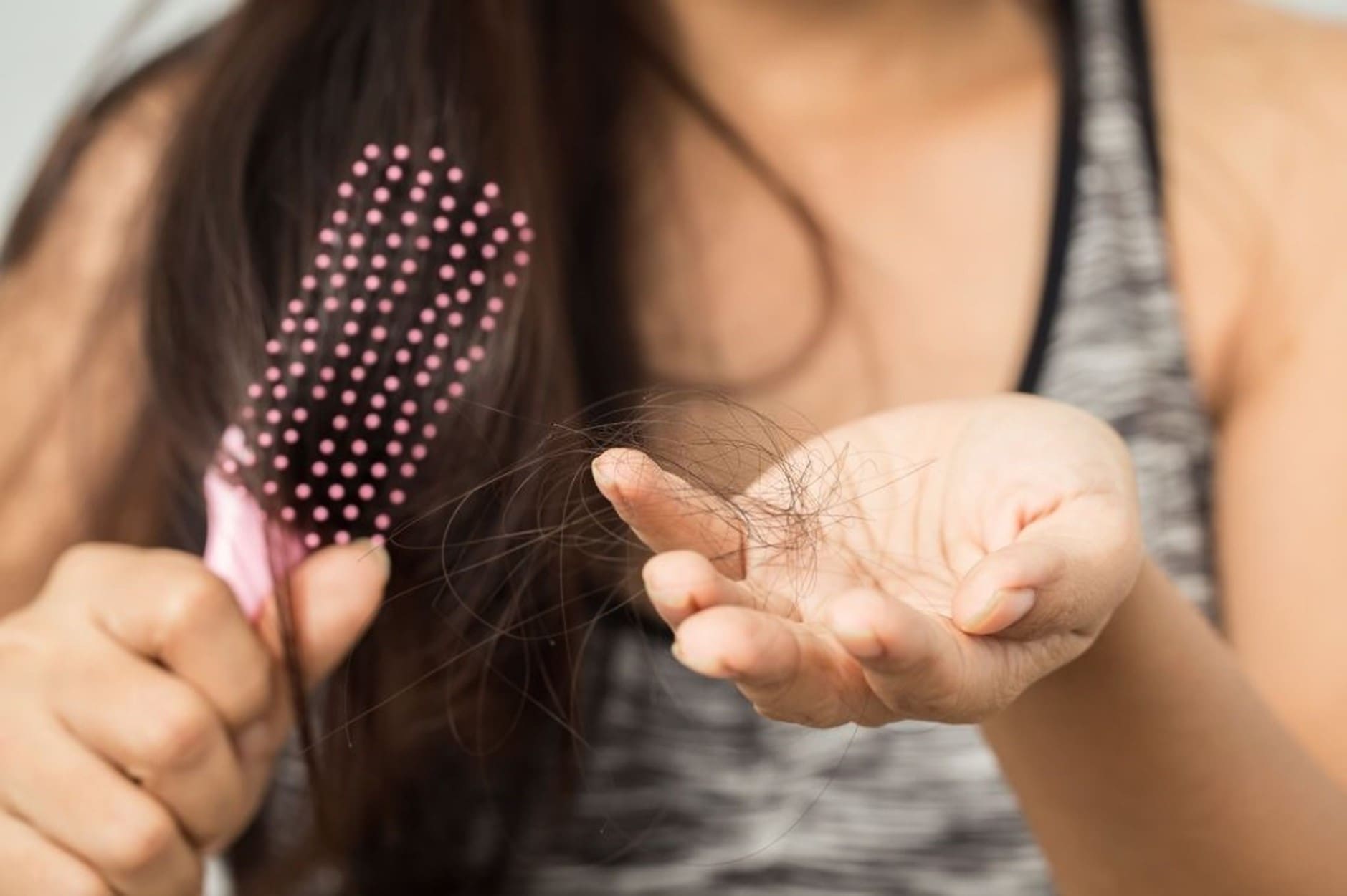 ANDROGENETSKA ALOPECIJA KOD ŽENA